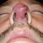 4a34ec77c02edd4cbd5607e3f7601360 1 - Фурункул в носу: причины появления и симптомы фурункулеза, фото, как лечить чирей