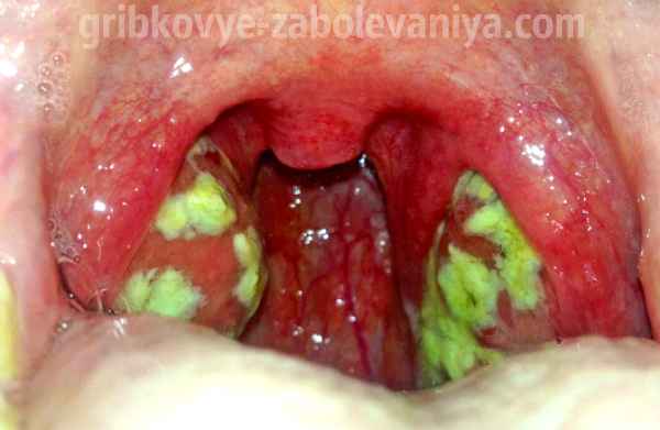 4b8b63fc46fad095d1022ee34aa5c231 1 - Грибковый тонзиллит: причины, симптомы, фото тонзилломикоза и лечение грибковой ангины у ребенка