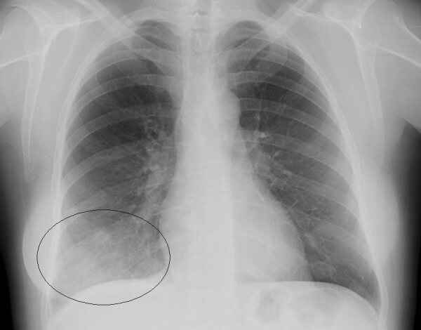4d5736f6b9629bb0e82a6b07d1c71e05 1 - Пневмония на рентгеновских снимках: различия признаков для разных форм болезни на рентгене и фото