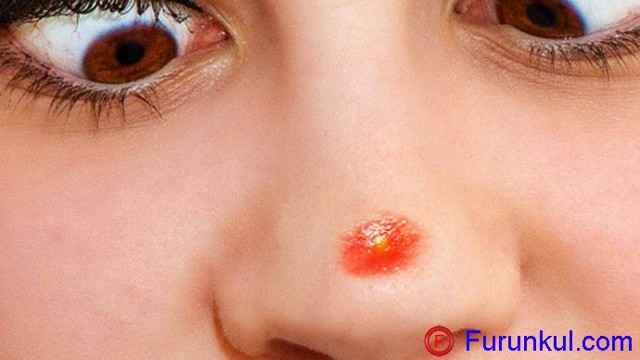4d967bc5c7c8c41dd7af009bd0de446b 1 - Фурункул в носу: причины появления и симптомы фурункулеза, фото, как лечить чирей