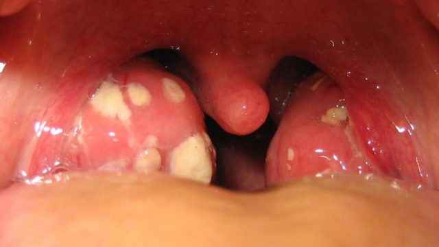 4dad5814459d432a19408ae4c430c00c 1 - Стафилококк во рту у взрослых и детей: причины появления и симптомы, фото и диагностика, способы лечения