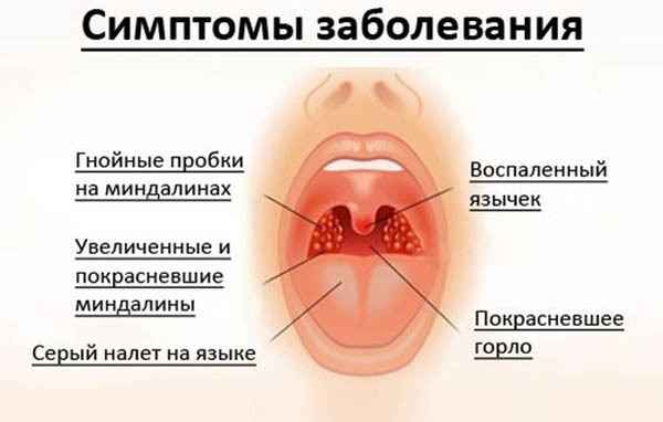 5233115bd38686d6416a1711de9a0b1b 1 - Как применять стрептоцид от горла: правила применения порошка при ангине, противопоказания и побочные эффекты