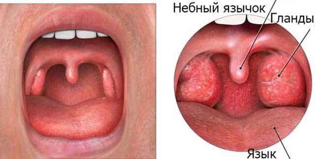 55859f8093ded9e2c705dd5b128b7eec 1 - Отечность небного язычка в горле (увулит): причины, из-за чего он может увеличиваться, симптомы и лечение