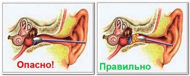 5ce25e39094239675ab00b7844ffd913 1 - Почему закладывает уши: причины и симптомы заложенности ушей, способы лечения в домашних условиях