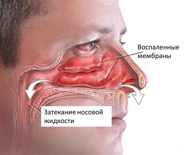 5f2016e11526fcfa00789ebab000b006 1 - Болит задняя стенка горла? — Фарингит: причины и методы лечения