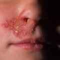 5f42df80ce94e357fe35f59e17c08f83 1 - Герпес в носу: симптомы заболевания, методы лечения, мази от герпеса