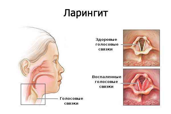 61052dd509d7e0347f9a840fdc4ac814 1 - Фарингит острый и хронический: симптомы и признаки воспаления глотки, лечение болезни горла