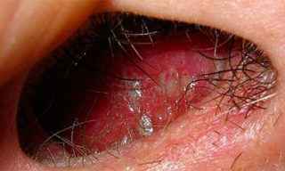 61fa83dd11243004c9cad36c6269ff3a 1 - Герпес в носу: симптомы заболевания, методы лечения, мази от герпеса