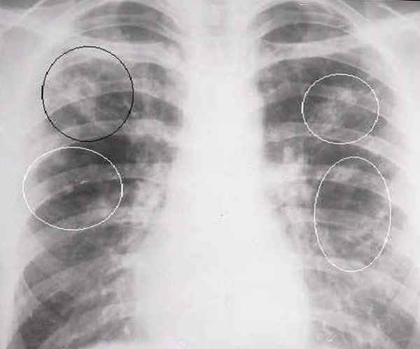 63e414b101069ba3f46757f686172317 1 - Что такое инфильтрация лёгочной ткани: признаки и симптомы инфильтрата в лёгких