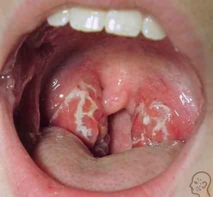 6907aacc7458aa515a0a384b02b3a0f8 1 - Грибок в горле: причины развития заболевания, фото кандидоза гортани и лечение
