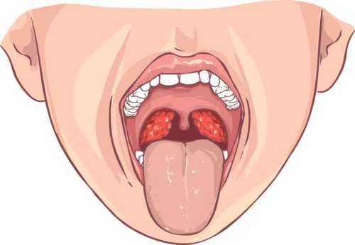 690c45f2c39fc09b879fc8a19a0756bf 1 - Миндалины в горле: основные причины, симптомы и лечение воспаления глоточных и небесных миндалин