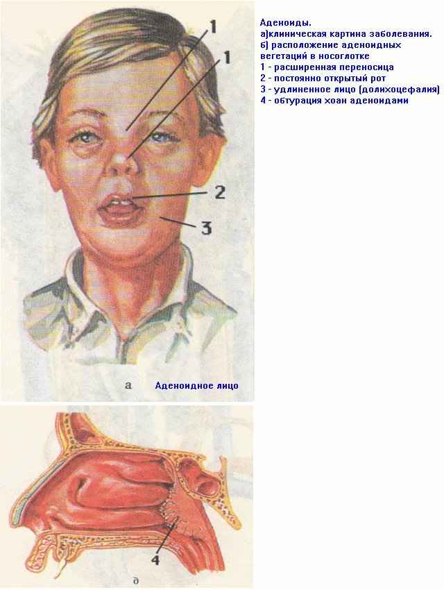 6a799ccf2e95928d71cf41dedb80ee10 1 - Аденоидный тип лица у ребёнка, где находиться и как выглядит, фото