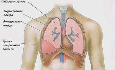 6c9842cdfa44f7873a0d0de729d04f4b 1 - Плеврит лёгких: особенности, симптомы, а также лечение и профилактика воспаления