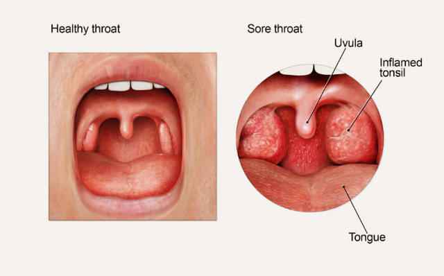 6fd889fff3fa71b37fb7359b7c1673a8 1 - Грибок в горле: причины развития заболевания, фото кандидоза гортани и лечение