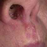 70256a9ab6de7bc35c728f4a1f528684 1 - Фурункул в носу: причины появления и симптомы фурункулеза, фото, как лечить чирей