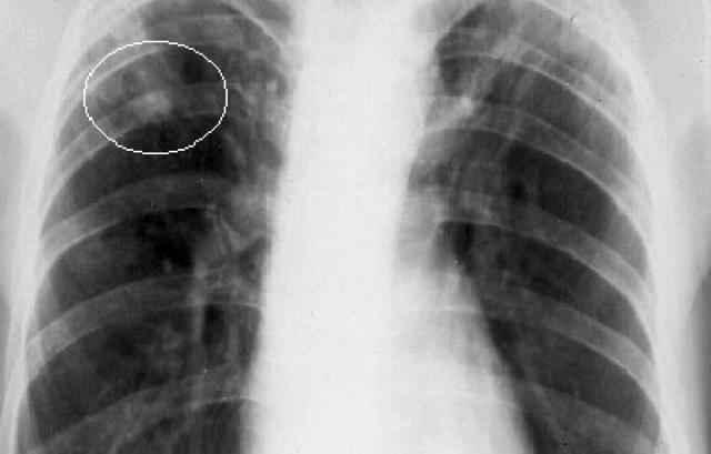 721fa8a4bad7708f82ccfdeb7d5b86c8 1 - Что такое инфильтрация лёгочной ткани: признаки и симптомы инфильтрата в лёгких