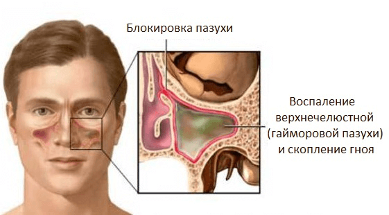 73d7ee7e74713f01bf4fdc2aff5ea142 1 - Интерферон для детей капли в нос: инструкция по применению грудничкам, противопоказания
