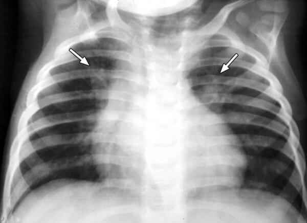 740e3ba4033acbebeedc525f84a9c739 1 - Пневмония на рентгеновских снимках: различия признаков для разных форм болезни на рентгене и фото