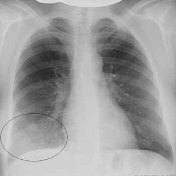 752cc128d804cac5e75e80472e1fb229 1 - Пневмония на рентгеновских снимках: различия признаков для разных форм болезни на рентгене и фото