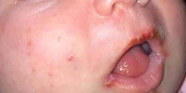 774e41dfa826d185f6d619bee4773e07 1 - Герпесная инфекция у детей: симптомы и последствия заражения