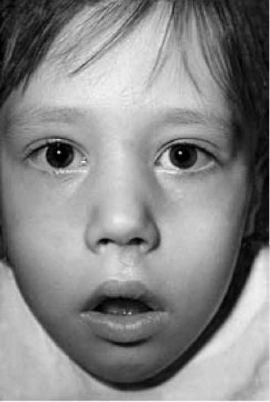 796ae59ff04131ecd8a06ea3f31b7128 1 - Аденоидный тип лица у ребёнка, где находиться и как выглядит, фото