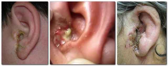 7b6d806fed9eaba162ce06464dc64c55 1 - Отит: симптомы этого заболевания, способы лечения воспаления уха, чем лечить отит?