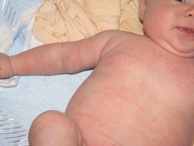800789df05b64827c50e2dab065aec9a 1 - Сыпь на теле у ребёнка без температуры: как выглядит сыпь и от чего она бывает