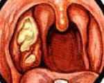 81bd5c22b54096f626059f1e729ccdf5 1 - Ангина симановского-венсана: причины развития язвенно-пленчатой ангины, лечение ангины плаута-венсана
