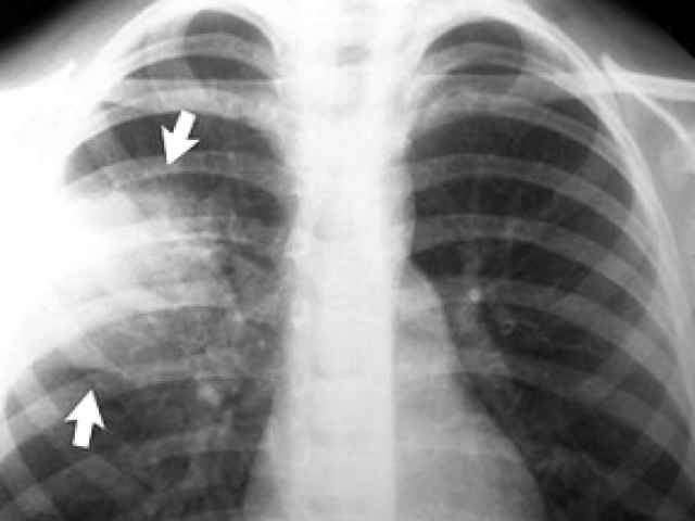 82506d04542bec2326192de4db76ca01 1 - Пневмония на рентгеновских снимках: различия признаков для разных форм болезни на рентгене и фото
