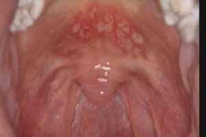 827433f45033dd05c1ff90e502865a67 1 - Гнойные язвочки во рту и причины их появления, а также виды болячек полости рта и их лечение
