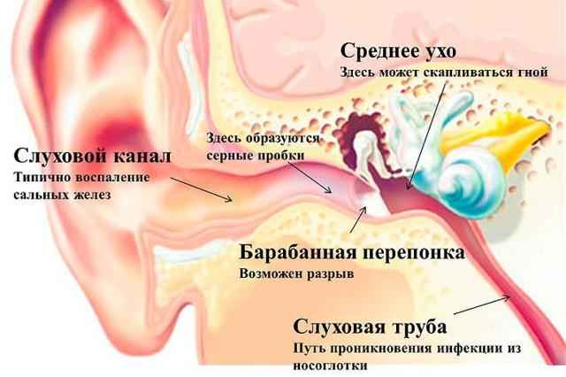 8320071db292d2491dd826201c1d6748 1 - Как удалить ушную пробку самостоятельно: польза ушной серы, причины и признаки, удаление из уха и профилактика