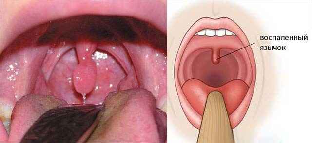 83fd14deb96af9350e7ecadc96b42cd2 1 - Отечность небного язычка в горле (увулит): причины, из-за чего он может увеличиваться, симптомы и лечение
