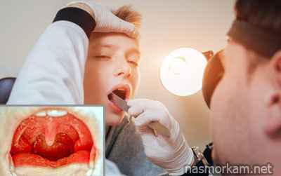 845fae5e34ec6411c37a2bb20367d69b 1 - Отечность небного язычка в горле (увулит): причины, из-за чего он может увеличиваться, симптомы и лечение