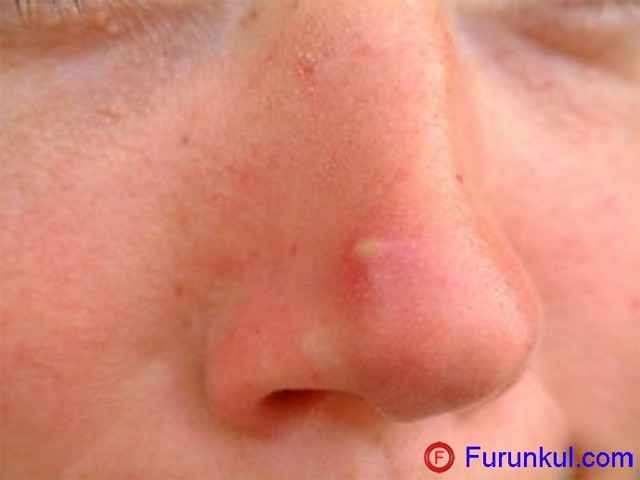 847ffe776ebbbb8ba2e206ff648ea47c 1 - Фурункул в носу: причины появления и симптомы фурункулеза, фото, как лечить чирей