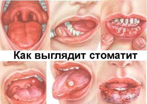 85378d3e454c84119c33f78587cb18e2 1 - Гнойные язвочки во рту и причины их появления, а также виды болячек полости рта и их лечение