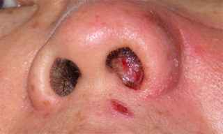 85d53ac6e5a8244924491b16f73f7df1 1 - Герпес в носу: симптомы заболевания, методы лечения, мази от герпеса