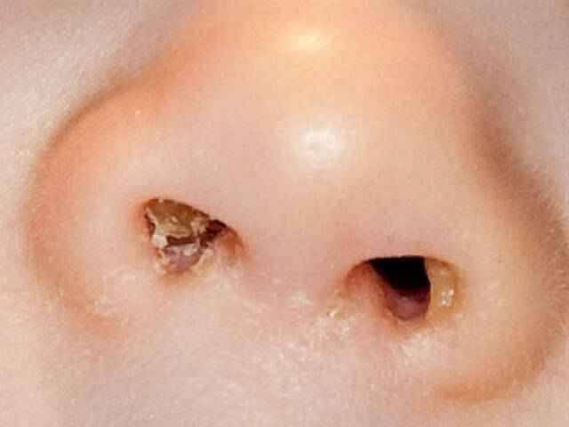 86b82a4d790aa03aa904abd2c254eb10 1 - Чем прочистить носик у новорожденного: причины появления слизи, как можно почистить нос грудничка от козявок