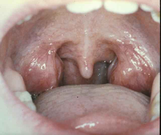 87e92965f55dfc900588095ca4579028 1 - Миндалины в горле: основные причины, симптомы и лечение воспаления глоточных и небесных миндалин