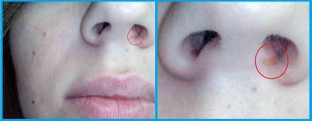 8903811b91a3fe61384418f092836645 1 - Прижигание слизистой носа лазером: возможные последствия процедуры по операции в носовых сосудах