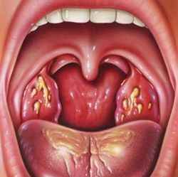 89bfa0d76fa728c24414164724af76be 1 - Причины и лечение сухого кашля, покашливания и постоянного першения в горле