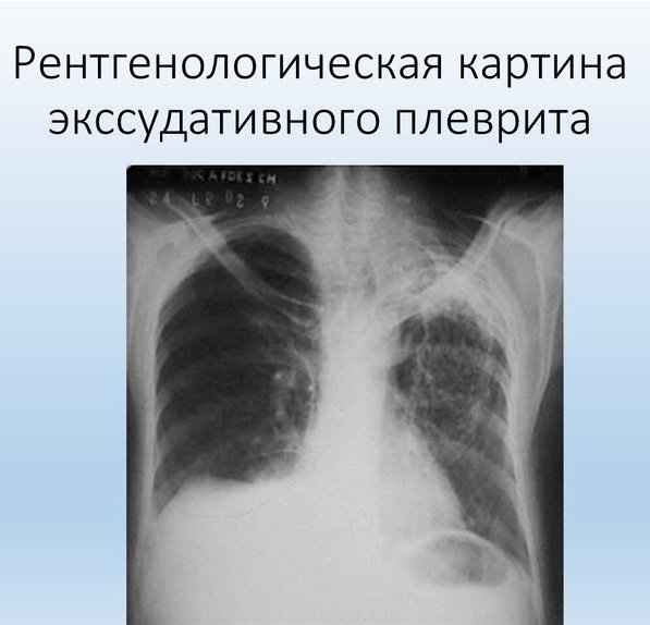 8ad46575bdcccbd029a4d7a6aef4212b 1 - Пневмония на рентгеновских снимках: различия признаков для разных форм болезни на рентгене и фото