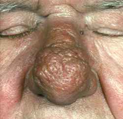 8c87632cf05c55beb08f85a2f6d1c12a 1 - Ринофима носа — симптомы, лечение и профилактика заболевания