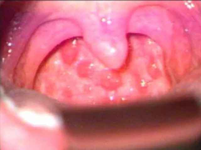 8ccf6060eee61f874e535611c28a0c09 1 - Грибковый тонзиллит: причины, симптомы, фото тонзилломикоза и лечение грибковой ангины у ребенка