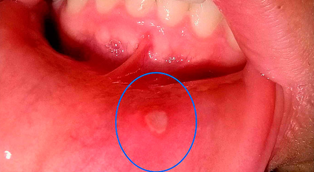 8cd73785cb58f5960edbe275d01764b8 1 - Гнойные язвочки во рту и причины их появления, а также виды болячек полости рта и их лечение