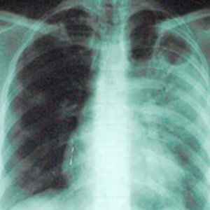 8cf9b21f37e005a2f5f98304a98420ed 1 - Туберкулезная болезнь: как лечить и как избежать заболевания, профилактика бактерии туберкулеза, палочки коха