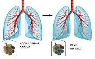 8d8bd6197e6278b61f39754067eaf5af 1 - Жидкость в лёгких: причины и лечение, последствие скопления воды в лёгких, жидкость в лёгких при онкологии
