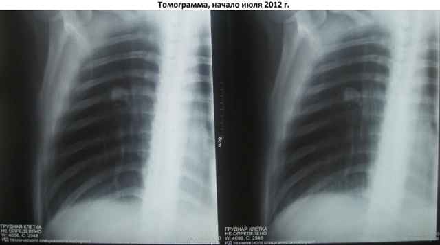 8f37c99711cf7b0508cbf02adcae2594 1 - Что такое туберкулома лёгких: заразна или нет, симптомы и последствия, лечение с помощью народных средств