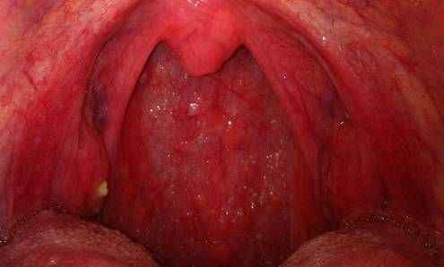 8f9e8277a64c5daec55269cbffd43ba6 1 - Фарингит острый и хронический: симптомы и признаки воспаления глотки, лечение болезни горла