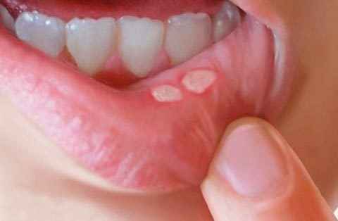 9409846ca449e41489cbdca9d1f88c4f 1 - Гнойные язвочки во рту и причины их появления, а также виды болячек полости рта и их лечение