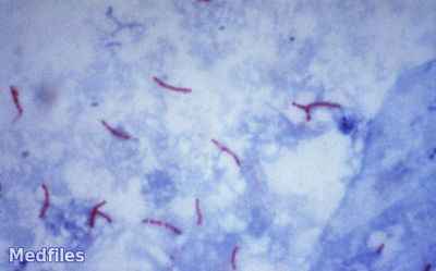 948d4d9063a378517e068a53e381a9c6 1 - Микобактерия туберкулёза (mycobacterium tuberculosis), характеристика, диагностика